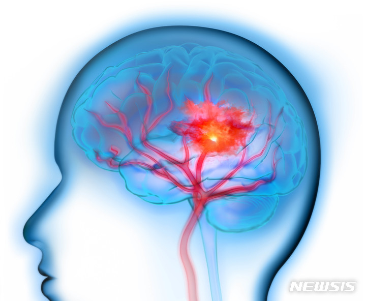 뇌졸중, 심혈관질환, 당뇨병 등 만성질환이 있는 사람은 더위로 인해 증상이 악화될 수 있으므로  더위에 오래 노출되지 않도록 주의해야 한다. 뉴시스